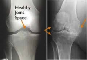 Lumbar Spine Anatomy -Redlands, Loma Linda, Highland