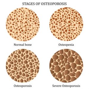 Bone Los Stages-osteoporosis