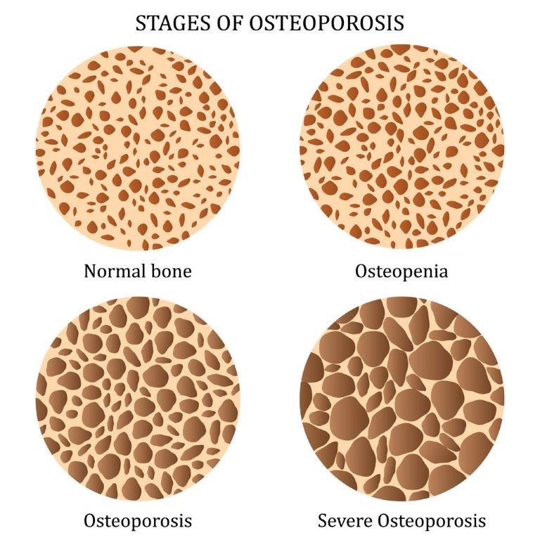 Exercises for Osteoporosis & Osteopenia