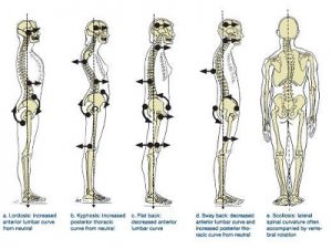 Posture Problems