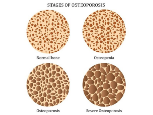 Exercise and osteoporosis