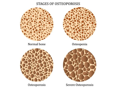 Strength Starts Within: Protect Your Bones